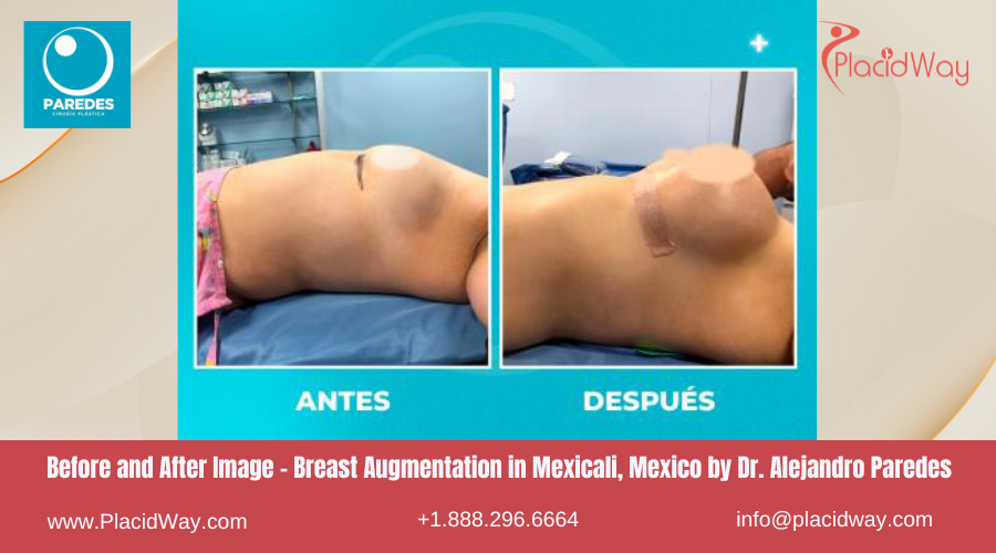 Breast Augmentation in Mexicali Mexico at Dr Paredes Center