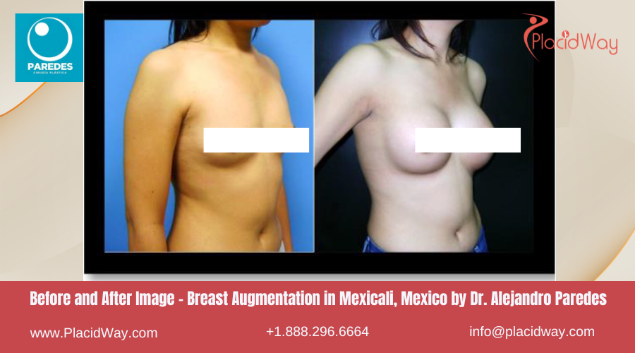 Breast Augmentation in Mexicali Mexico by Dr Alejandro Paredes