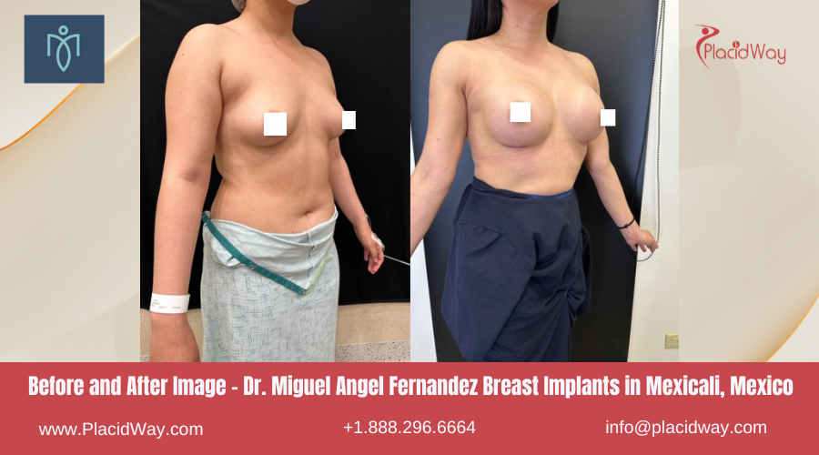 Breast Augmentation in Mexicali Mexico by Dr. Miguel Angel Fernandez