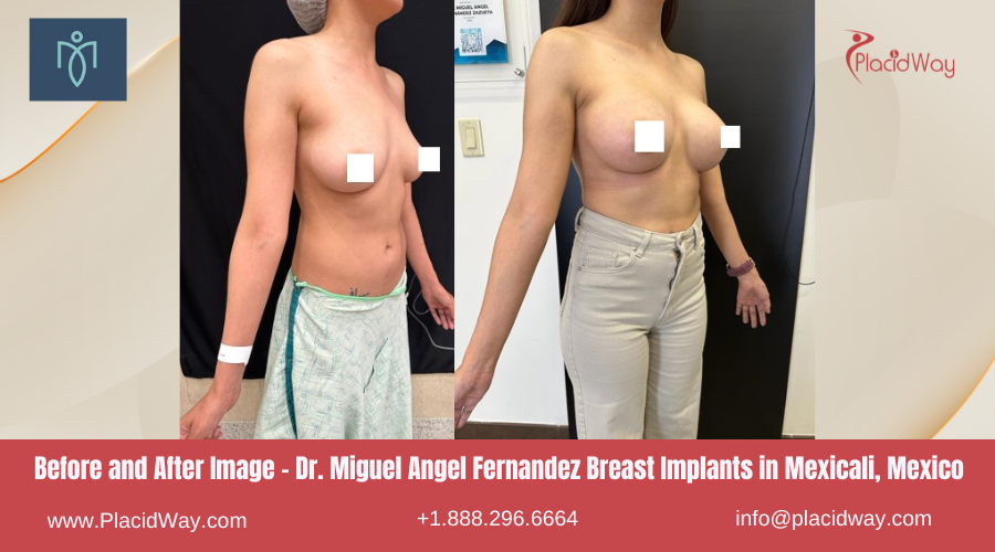 Breast Augmentation in Mexicali Mexico at Dr. Miguel Angel Fernandez