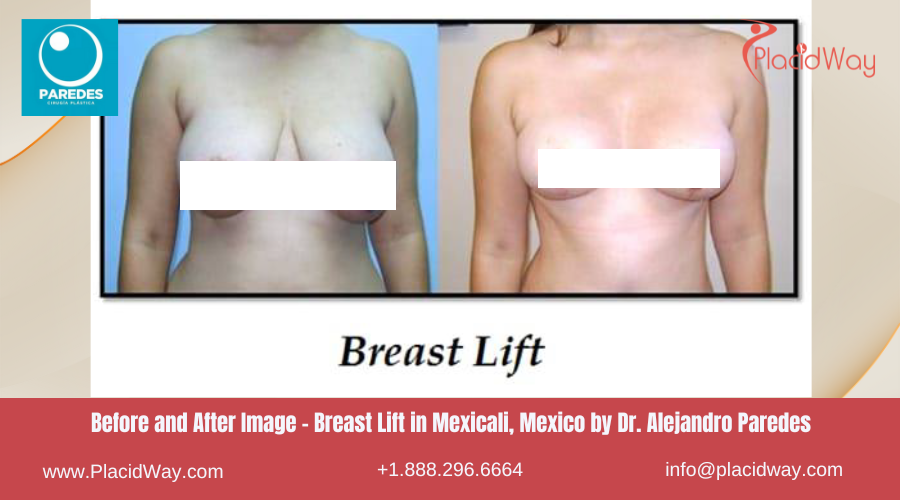 Breast Lift in Mexicali Mexico by Dr Paredes