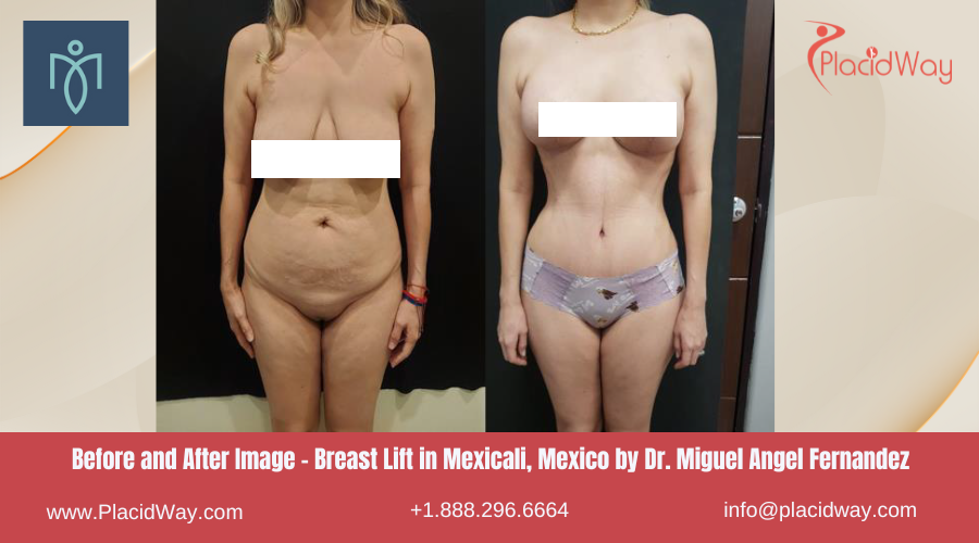 Breast Lift in Mexicali Mexico by Miguel Angel Fernandez