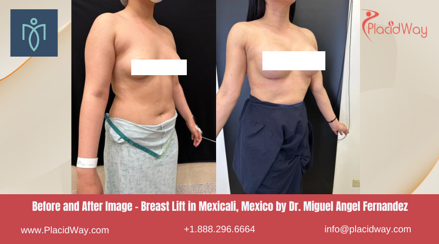 Breast Lift in Mexicali Mexico at Miguel Angel Fernandez Clinic