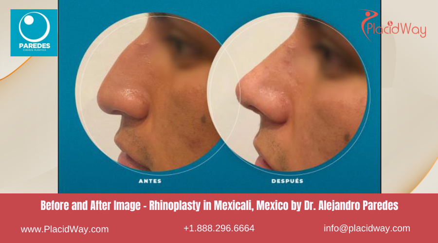 Rhinoplasty in Mexicali Mexico at Dr Paredes Clinic