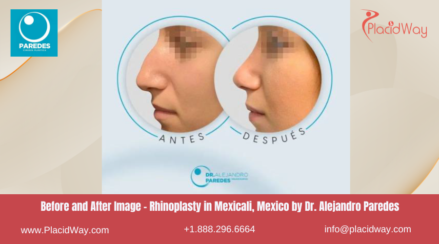 Rhinoplasty in Mexicali Mexico by Dr Paredes Clinic