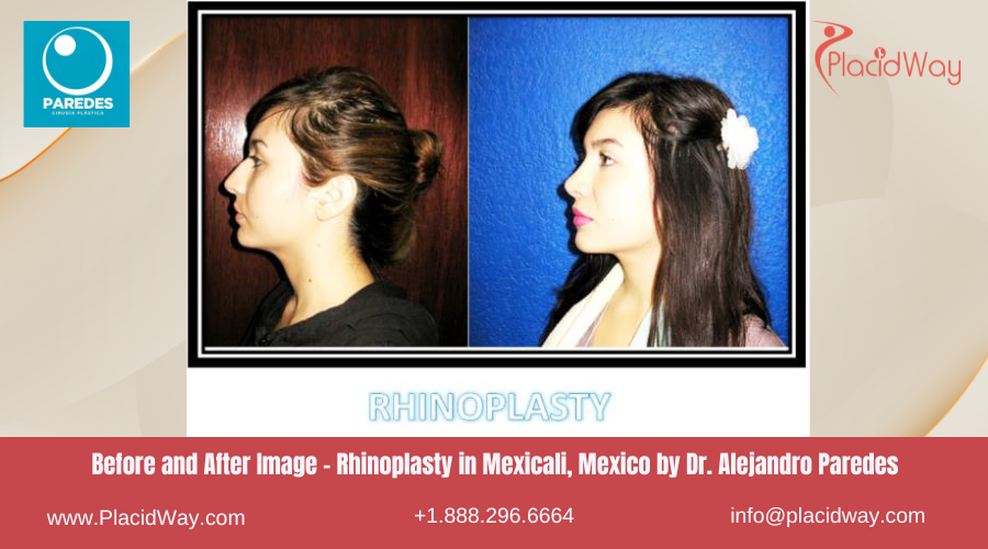 Rhinoplasty in Mexicali Mexico by at Alejandro Paredes Clinic