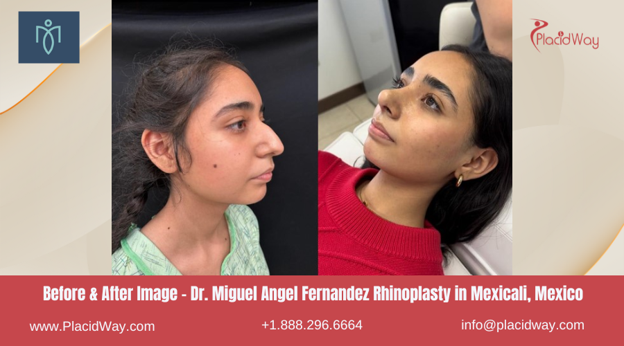 Rhinoplasty in Mexicali Mexico by Dr Miguel Angel Fernandez