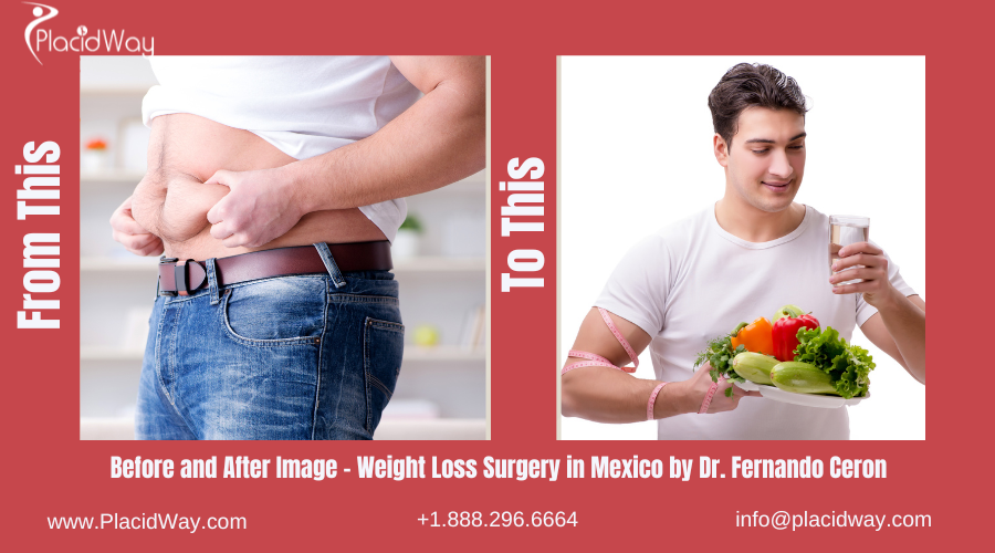 Before and After Weight loss surgery of Tommy Davidson in Mexico