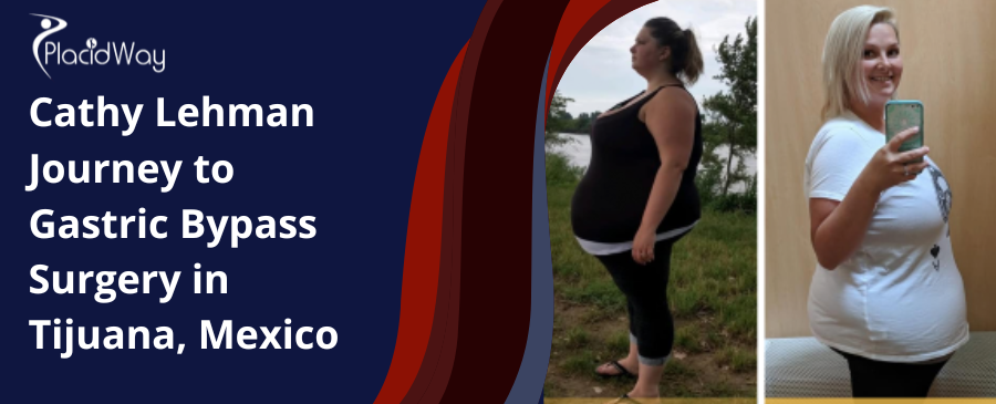 Cathy Lehman Journey to Gastric Bypass Surgery in Tijuana, Mexico