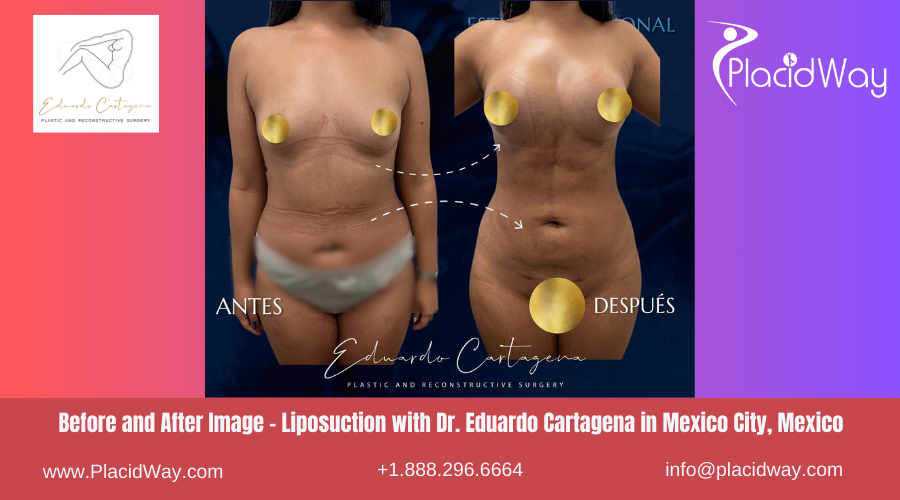 Liposuction in Mexico City, Mexico Before After Images