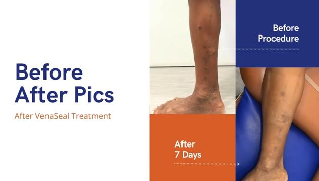 Before and after results of Varicose Veins Treatment in Mumbai, India.