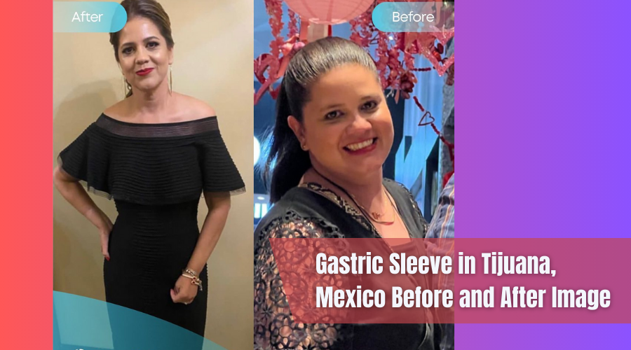 Before After Gastric Sleeve in Tijuana Mexico by Maytorena