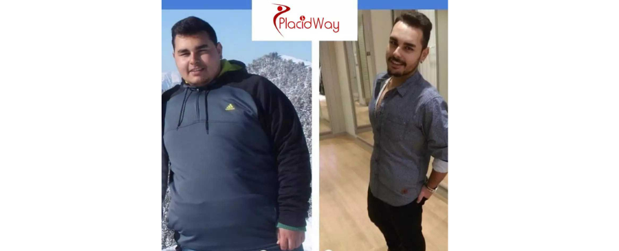 Gastric Sleeve Success Story at Cevre Hospital in Turkey