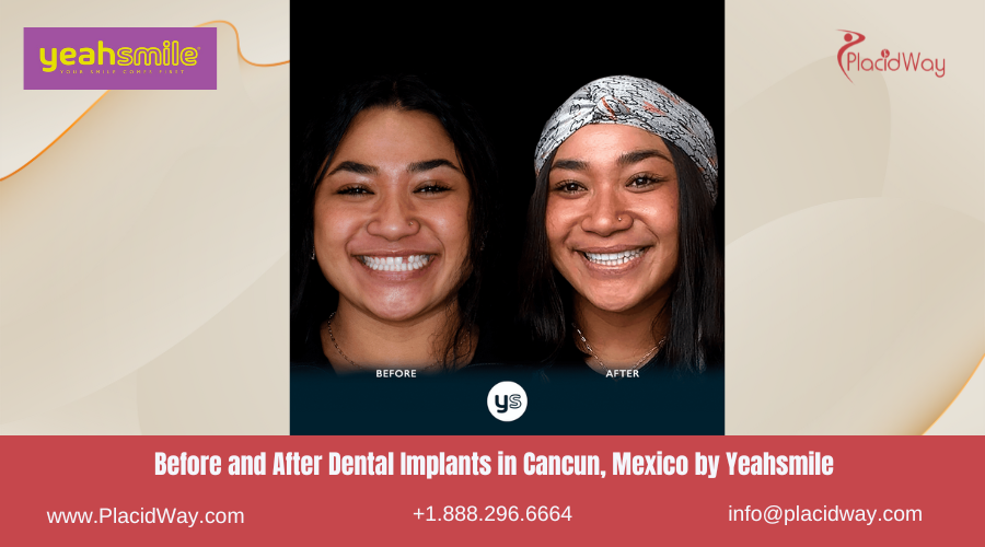 Before and After Dental Implants in Cancun, Mexico by Yeahsmile