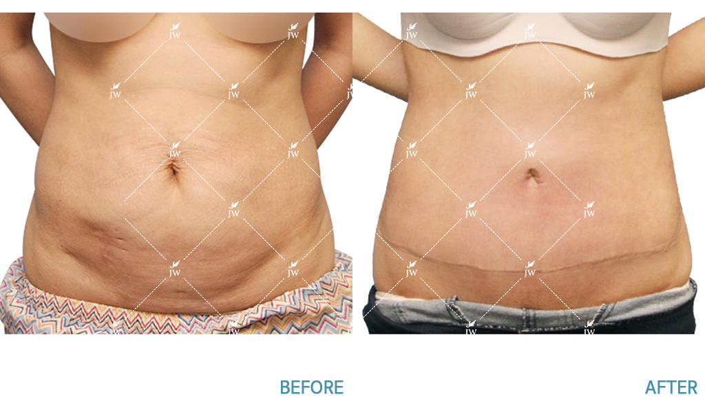 Body Contouring Before & After in PW Plastic Surgery in Seoul South Korea1