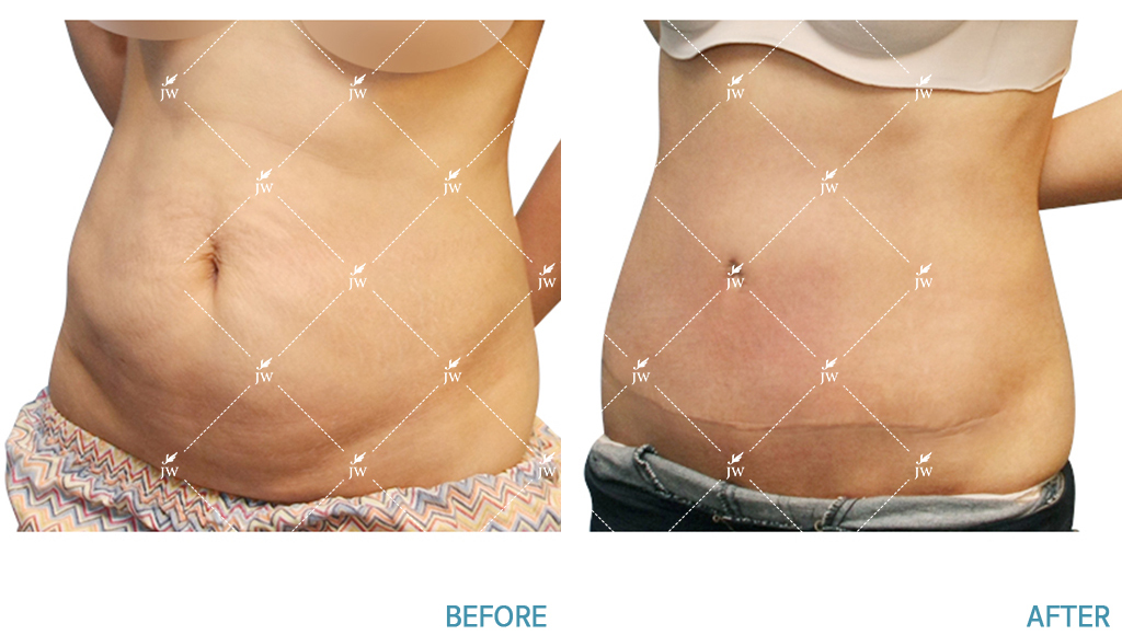 Body Contouring Before & After in PW Plastic Surgery in Seoul South Korea1