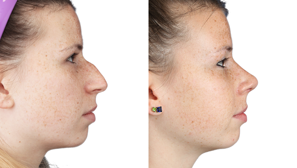 Rhinoplasty Before and After in JW Plastic Surgery in Seoul South Korea