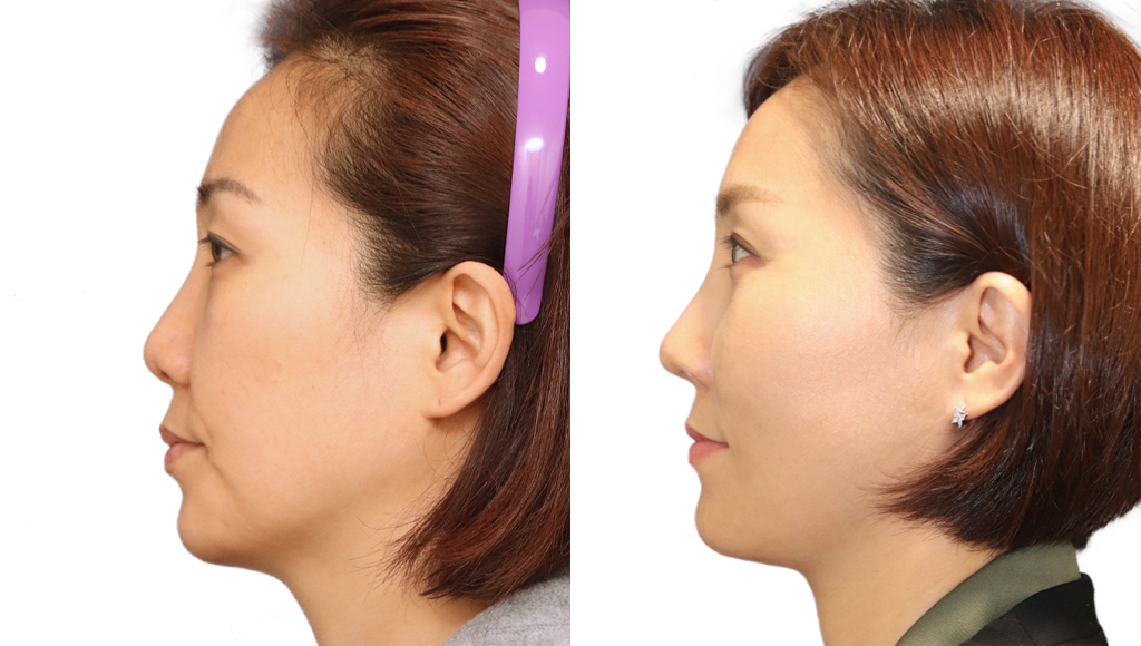 Rhinoplasty Before and After in JW Plastic Surgery in Seoul South Korea