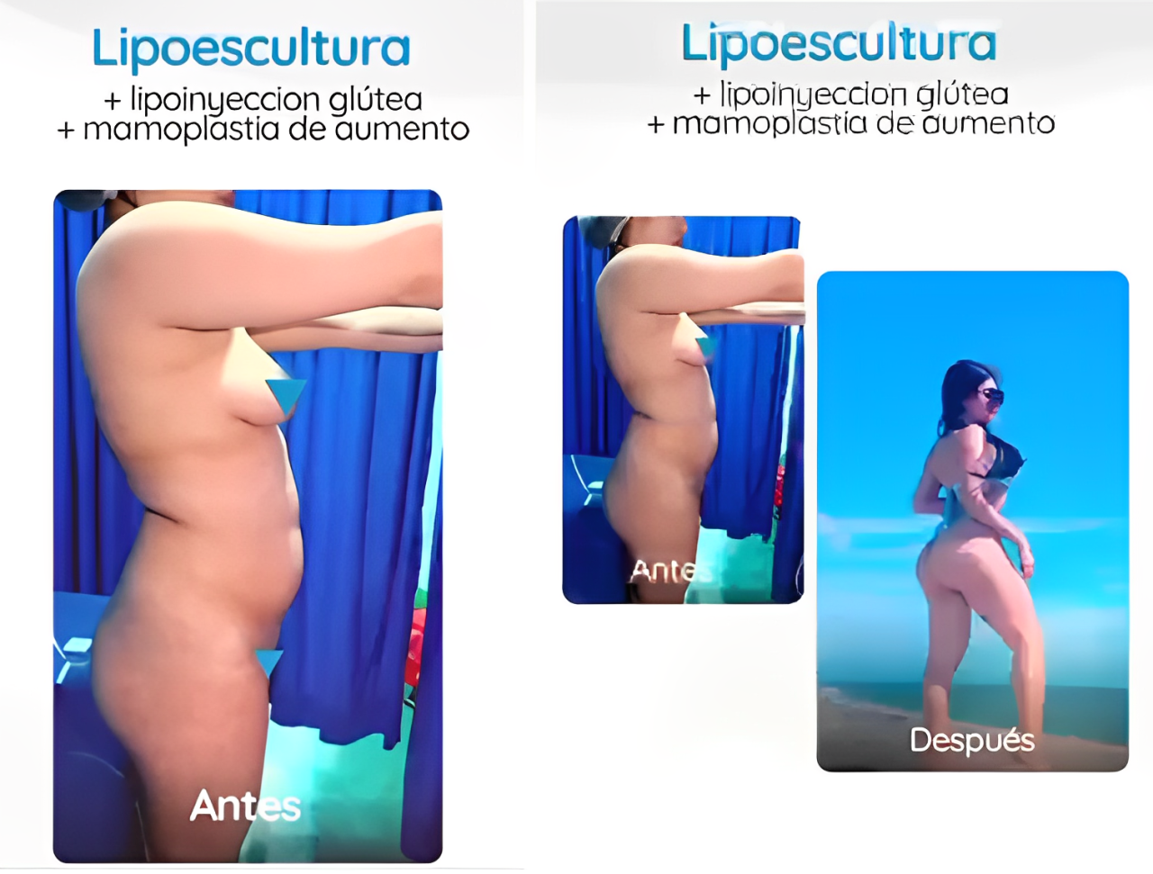 Liposculpture Colombia