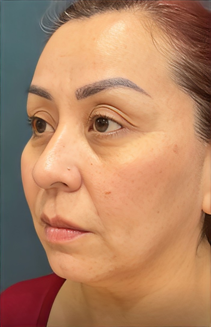 Facelift in Santo Domingo Dominican Republic