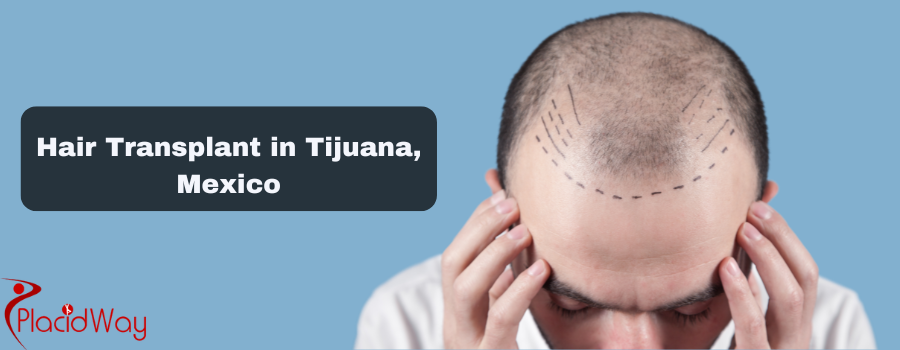 Hair Transplant in Tijuana, Mexico