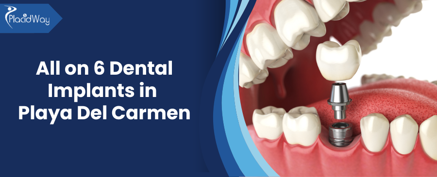 All On  Dental Implants Clinics In Playa Del Carmen