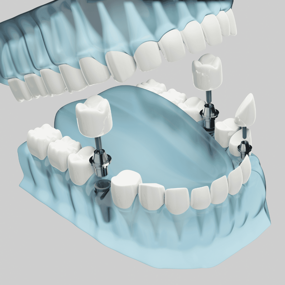 All on 4 Dental Implants Package in Tijuana, Mexico by Dental Solutions Tijuana
