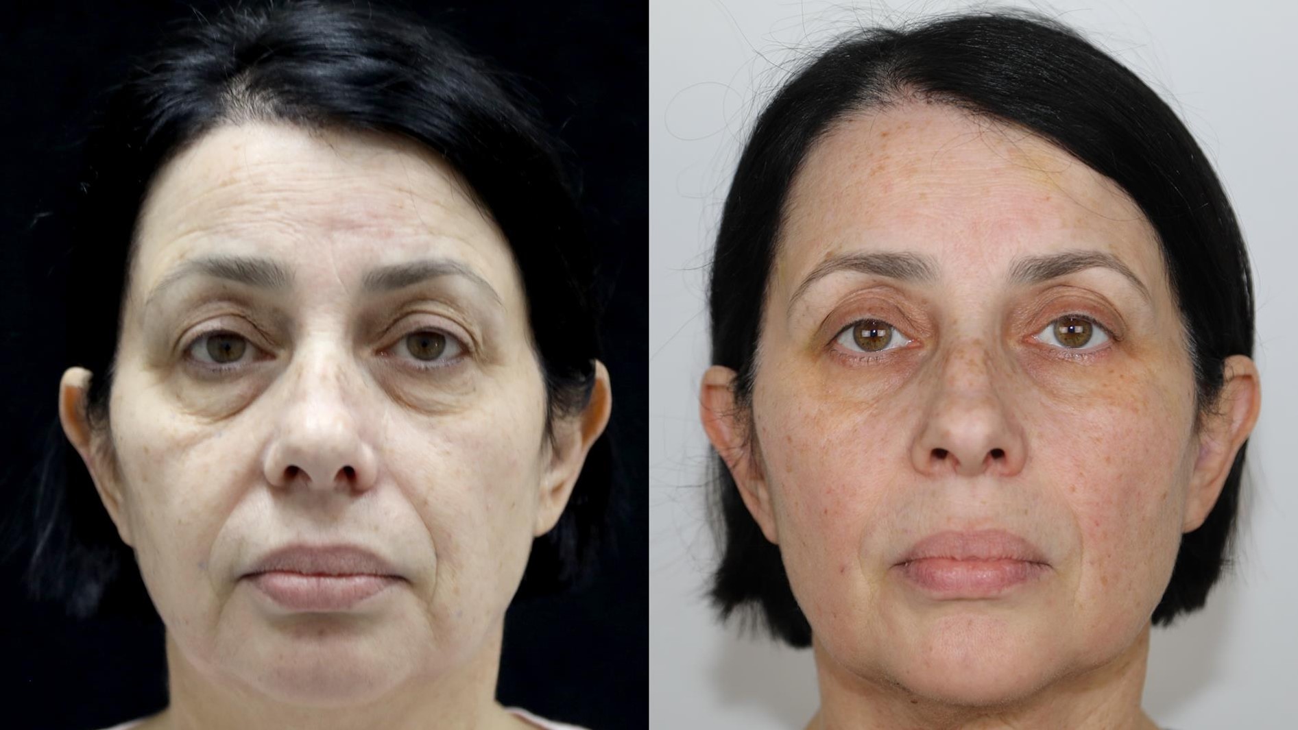 Non surgical  face anti-aging 