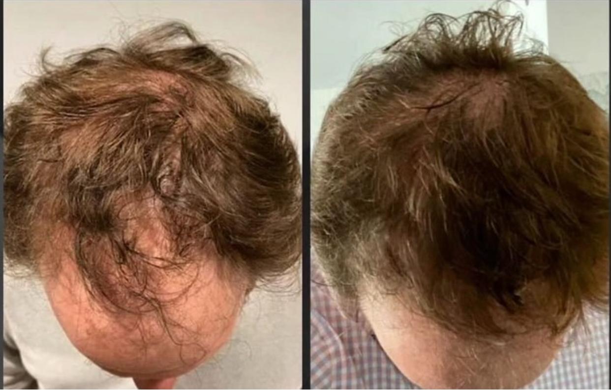 Hair loss treatment program