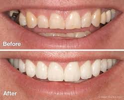 Full Smile Makeover Package